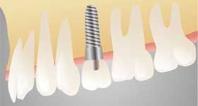 Impianti dentali